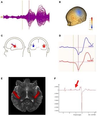 Contributions to auditory system conduction velocity: insights with multi-modal neuroimaging and machine learning in children with ASD and XYY syndrome